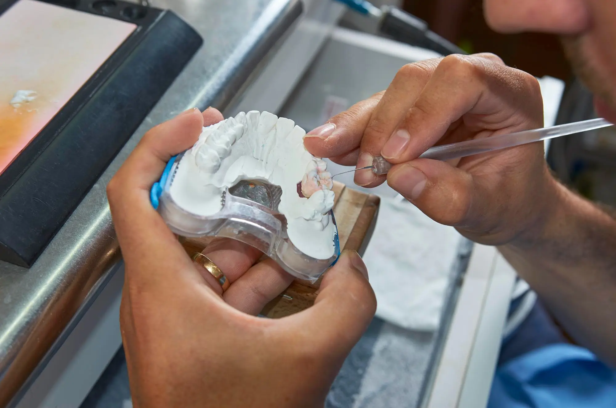 Anfertigung und Einsetzen der Krone